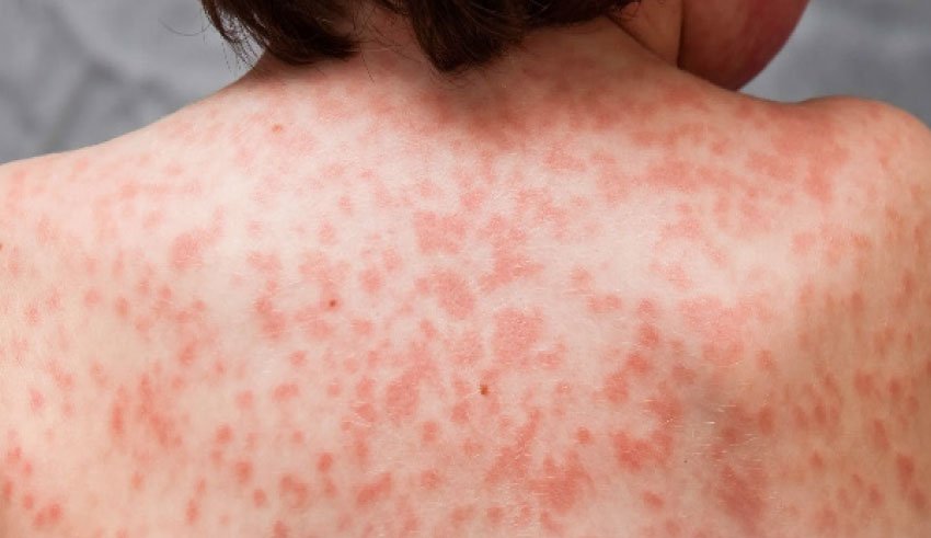 La maladie de Kawasaki