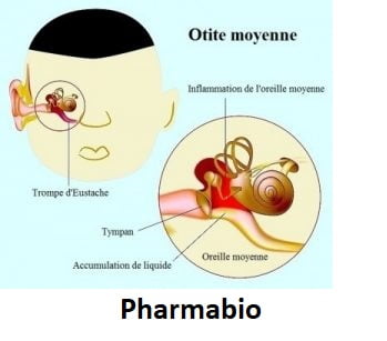 Soigner Otite Naturellement