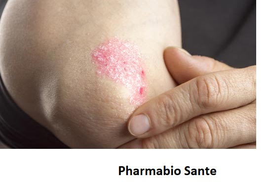 Maladie de la Gale: Solution naturel