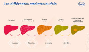 Curcuma et Foie gras