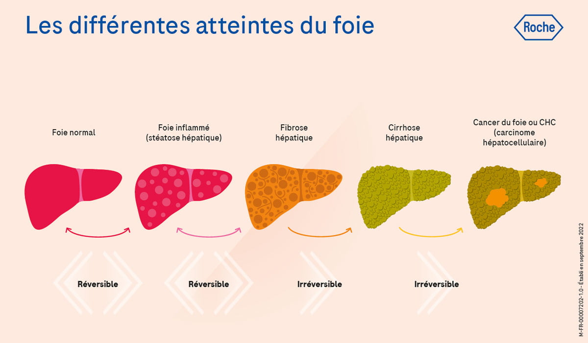 Curcuma et Foie gras
