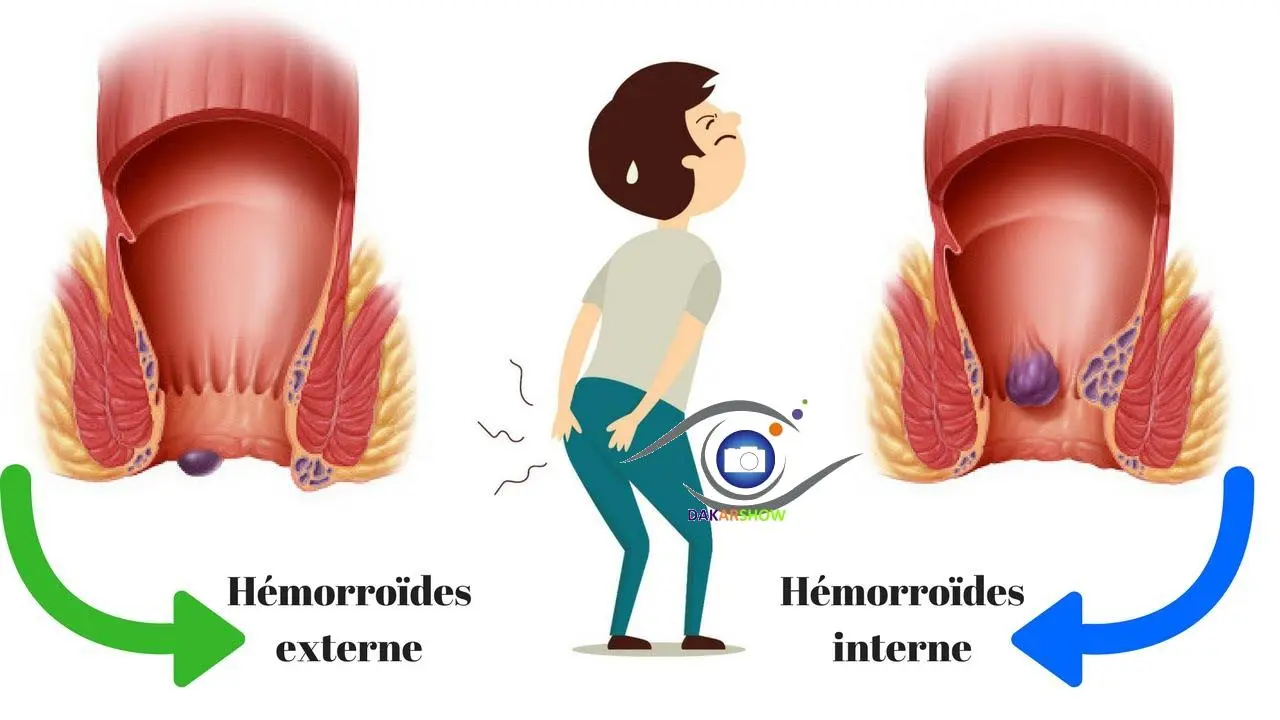 Comment soigner les hémorroïdes naturellement