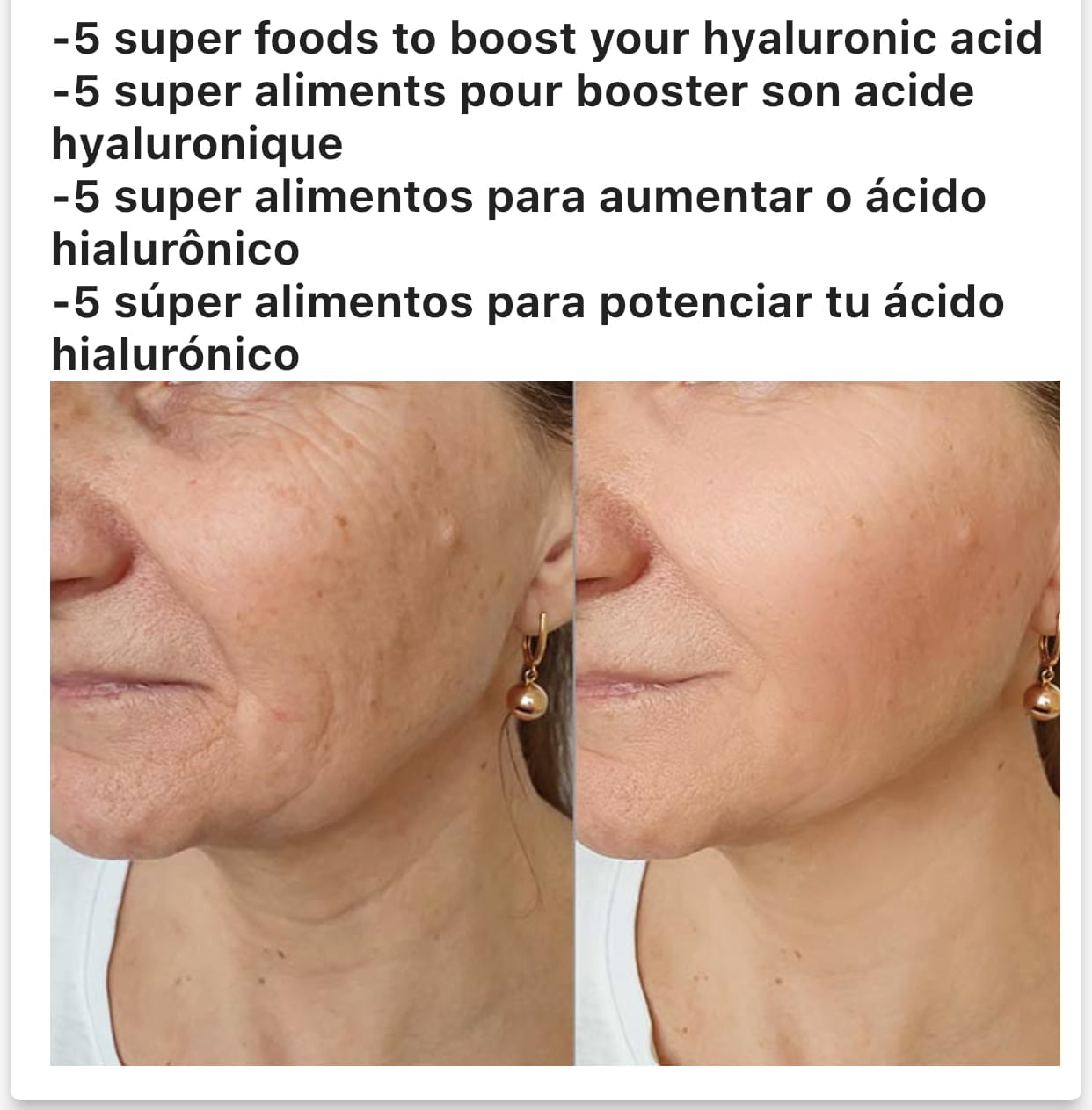 Booster son acide hyaluronique