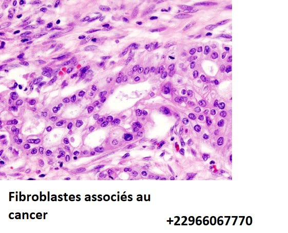 Fibroblastes associés au cancer