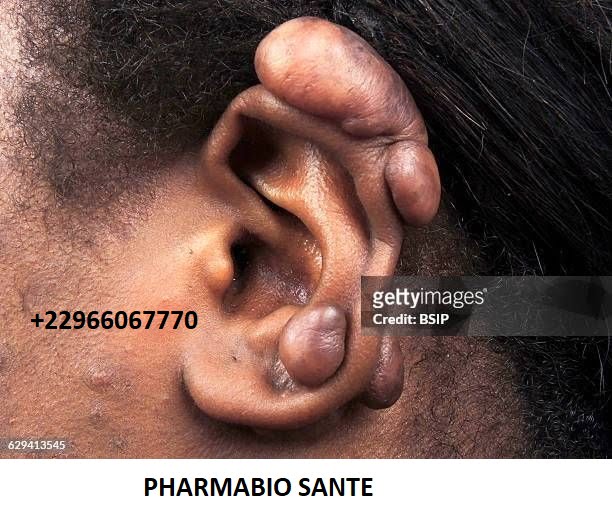 Comment soigner chéloïdes définitivement