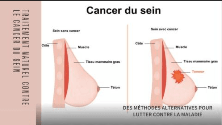 Comment traiter le cancer du sein