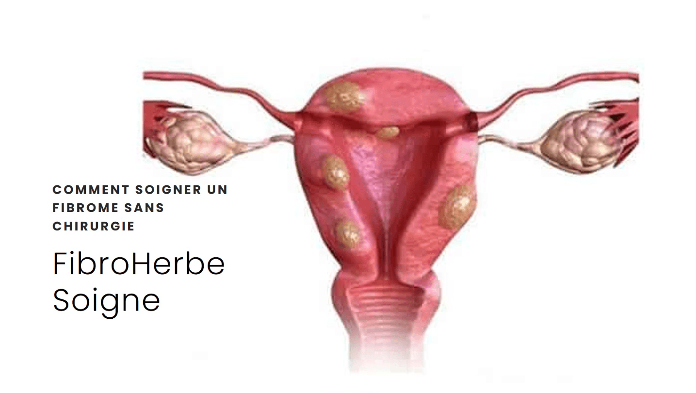 soigner un fibrome sans chirurgie