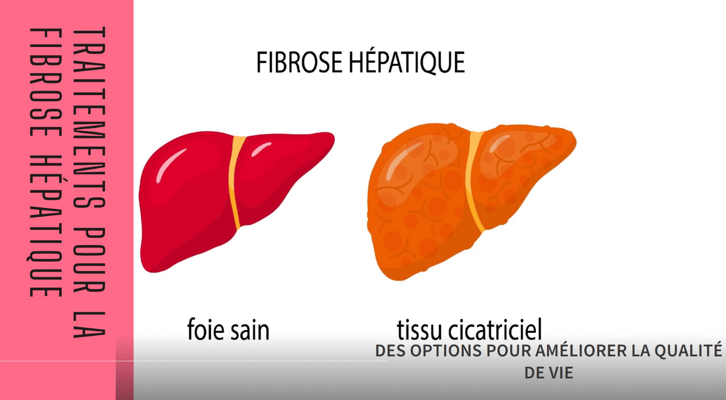 Fibrose Hépatique Traitements