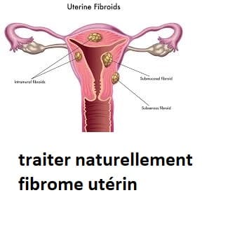 Fibrome utérin traitement naturel
