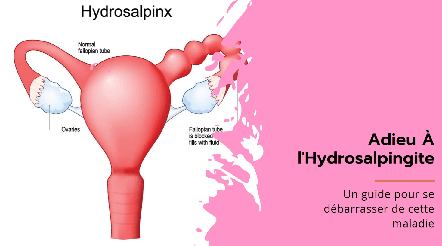 Comment Se Débarrasser De L'Hydrosalpingite