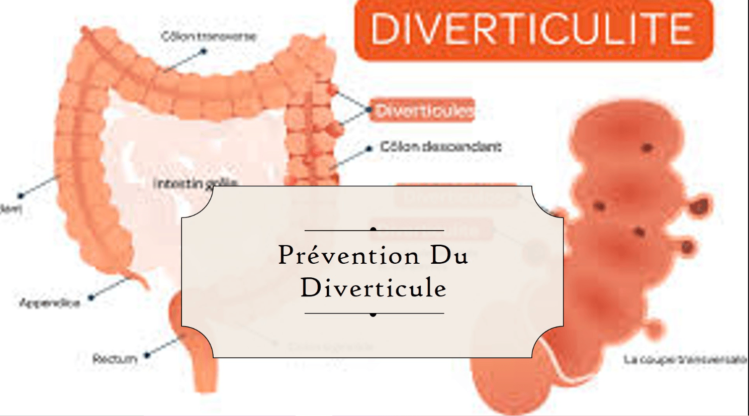 Le diverticule du côlon