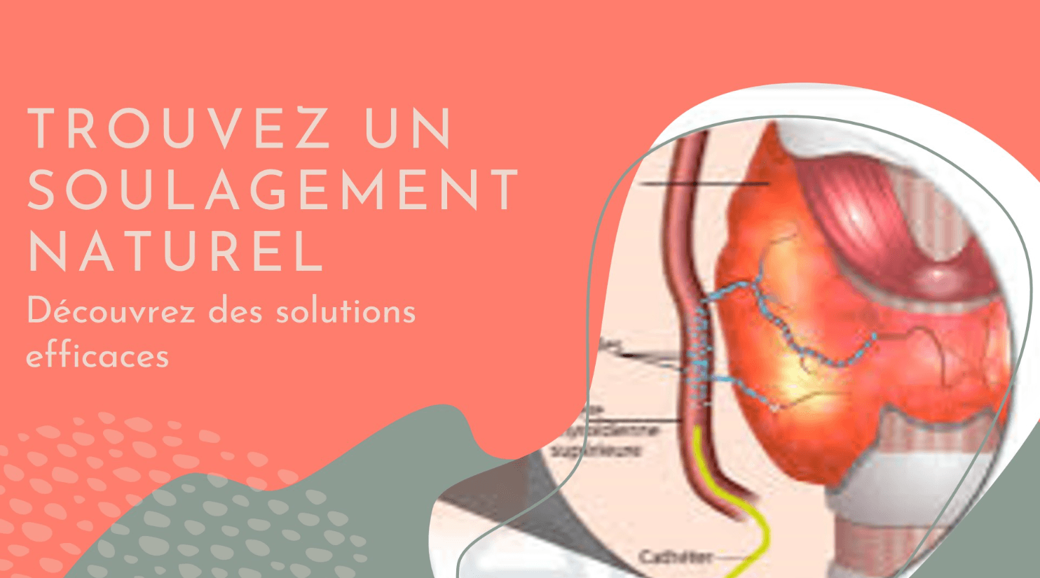 Goitre Solution Naturelle