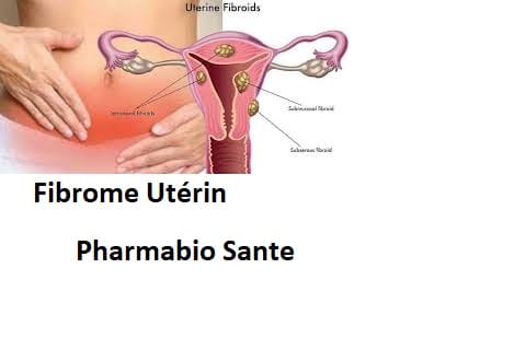 Fibrome Utérin