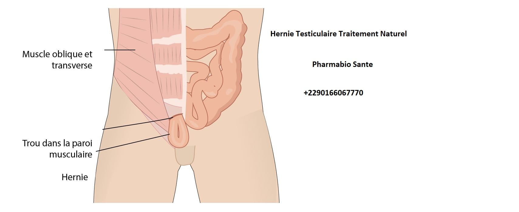 Hernie Testiculaire Traitement Naturel