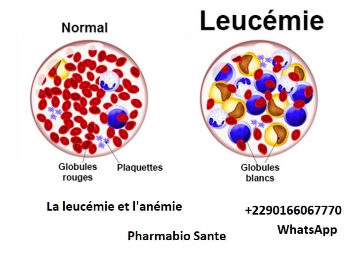 La leucémie et l'anémie