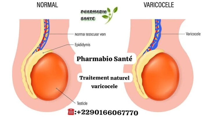 plantes africaines varicocèle