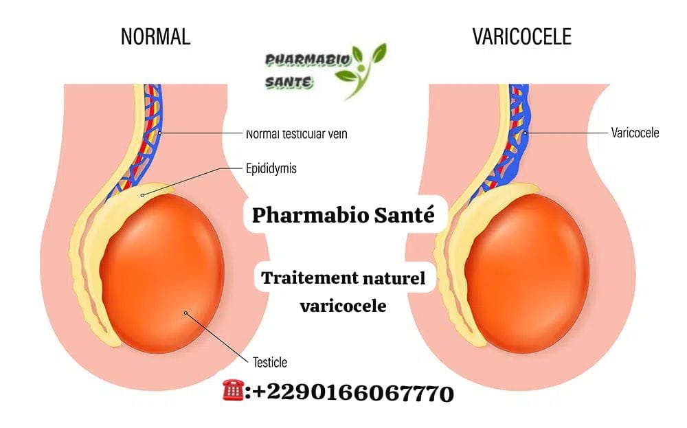 plantes africaines varicocèle