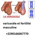 varicocèle silencieuse