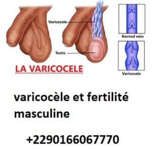 varicocèle silencieuse