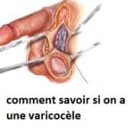quand consulter varicocèle