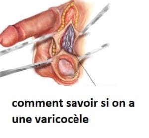 quand consulter varicocèle