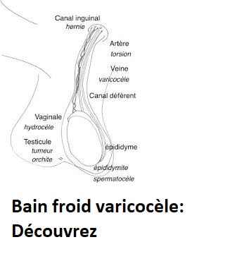 Bain froid varicocèle