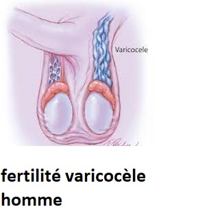 fertilité varicocèle homme