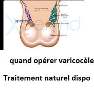 quand opérer varicocèle