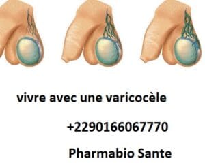 vivre avec une varicocèle