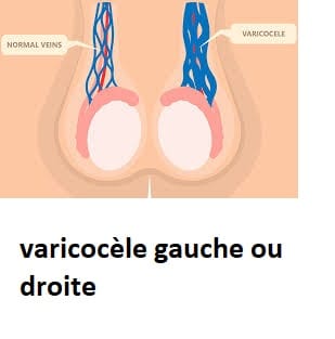 varicocèle gauche ou droite