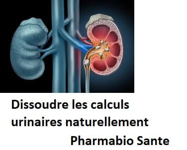 Dissoudre les calculs urinaires naturellement