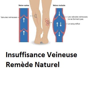 Insuffisance Veineuse Remède Naturel