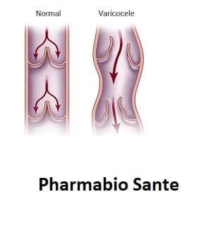 éviter chirurgie varicocèle