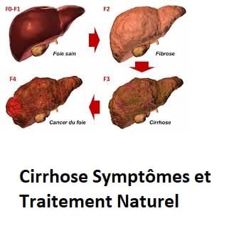 Cirrhose Symptômes et Traitement Naturel