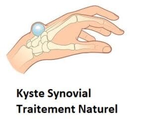 Kyste Synovial Traitement Naturel