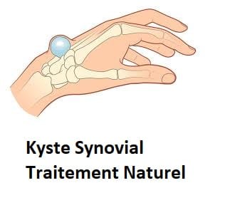Kyste Synovial Traitement Naturel
