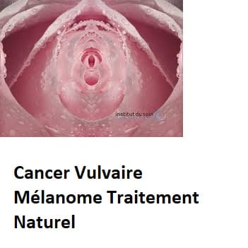 Cancer Vulvaire Mélanome Traitement Naturel