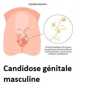 Candidose génitale masculine