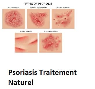 Psoriasis Traitement Naturel