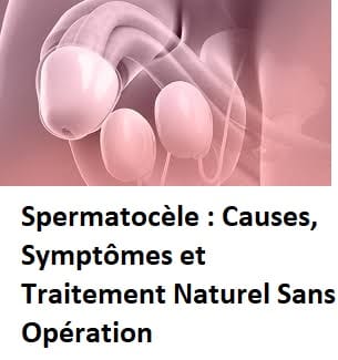 Spermatocèle Traitement Naturel