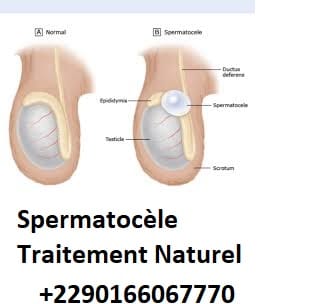 Spermatocèle Définition et Solution Naturelle
