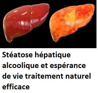 Stéatose hépatique alcoolique et espérance de vie traitement naturel efficace
