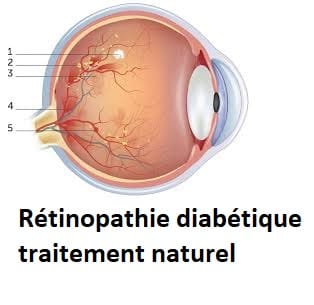 Rétinopathie diabétique traitement naturel