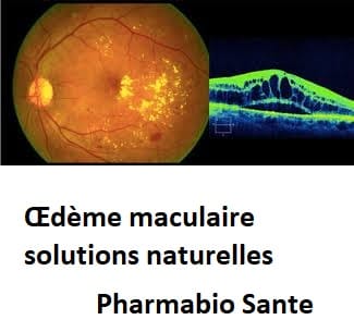 Œdème maculaire solutions naturelles