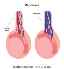 Varicocèle pharmabio