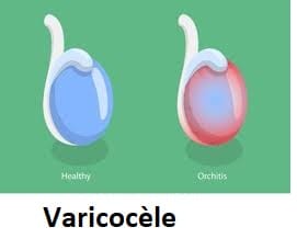 Varicocèle