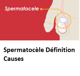 Spermatocèle Définition Causes