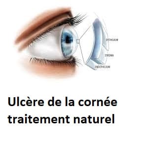 Ulcère de la cornée traitement naturel