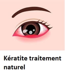Kératite traitement naturel