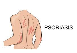 Psoriasis traitement naturel
